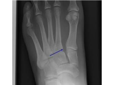 Orthotics as a Key Treatment Modality for Lisfranc Injuries – Pre and Post-Surgery